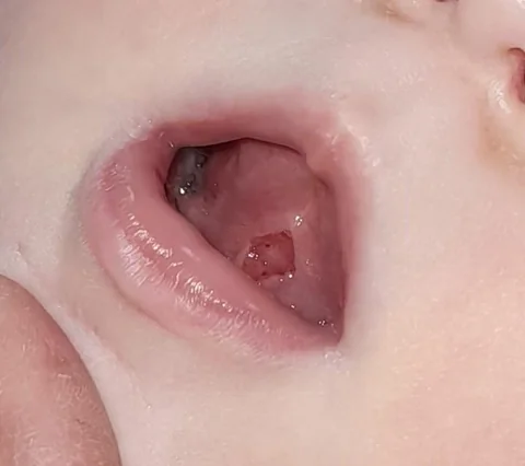 13 weeks old — after the procedure