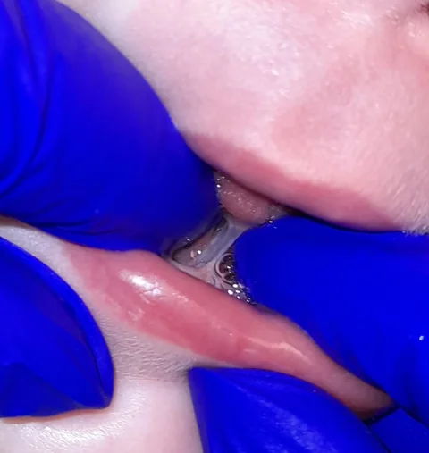 19 weeks old — before the procedure